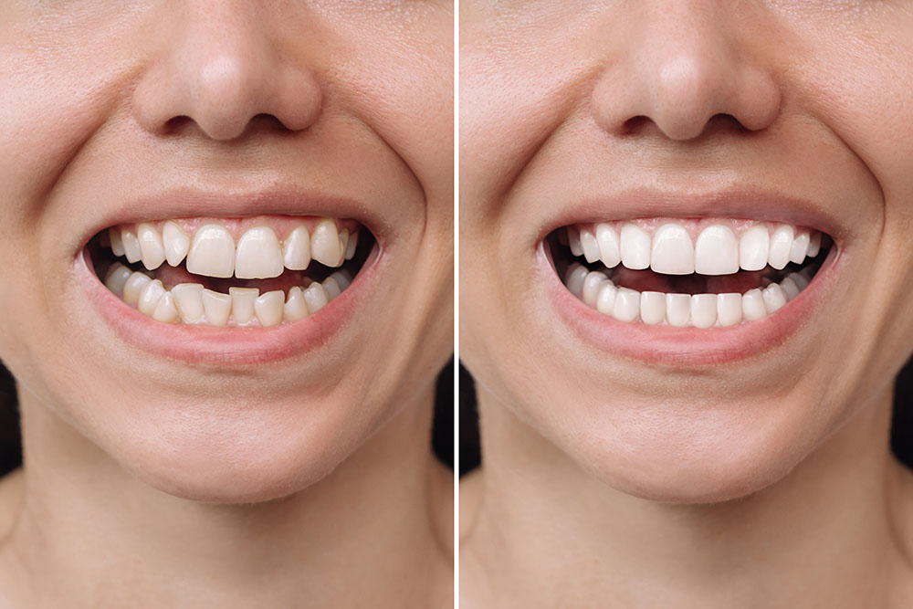 The Benefits of Composite Bonding Over Traditional Fillings in London